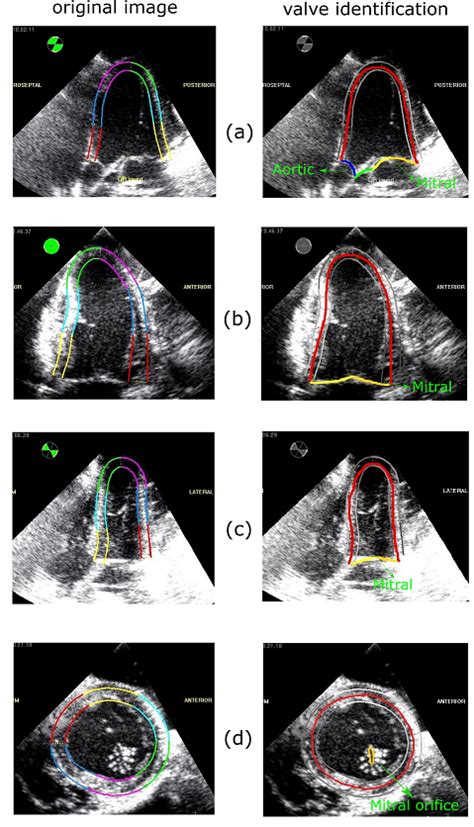 2d echo with cfd|A hybrid echocardiography.